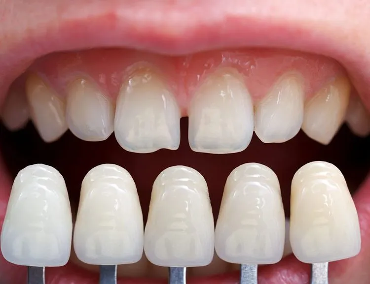 Best Porcelain Veneers for Your Smile